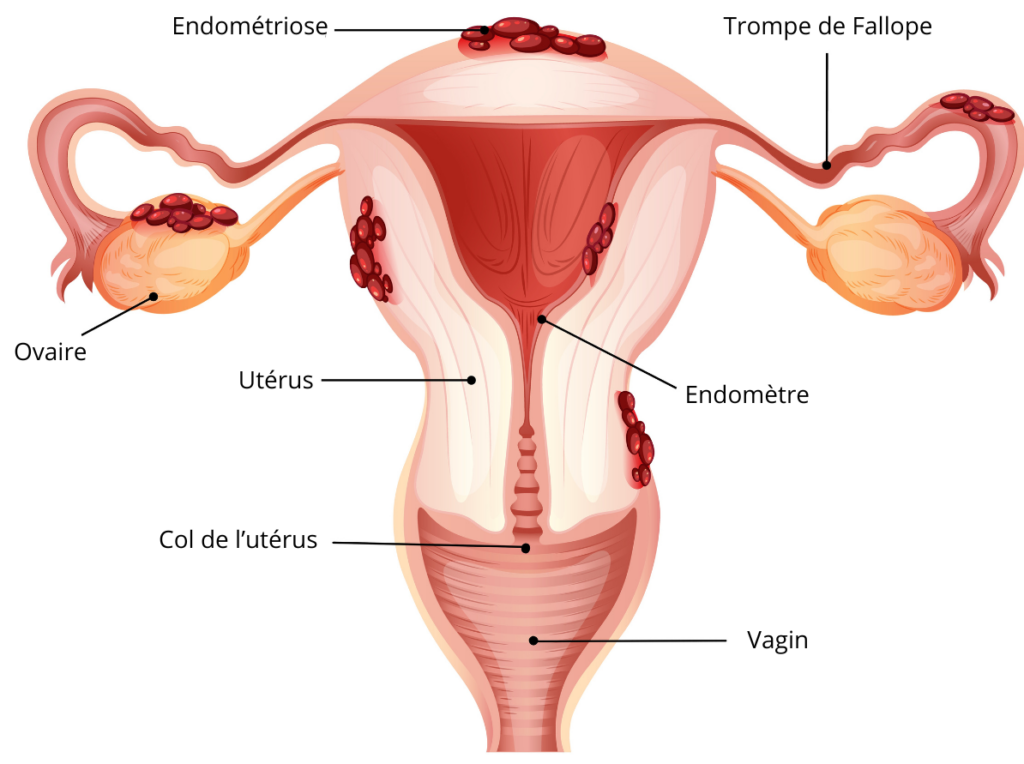 Endométriose sur l'appareil génital féminin